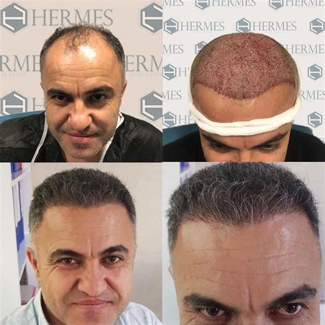 hermes hair clinic saç ekim sonuçları|HERMEST'te Saç Ekimi Yaptıran Muhabirimizin Yorumları ve .